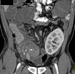 Pancreatitis in A Pancreatic Transplant in RLQ. Renal Transplant Also Seen - CTisus CT Scan