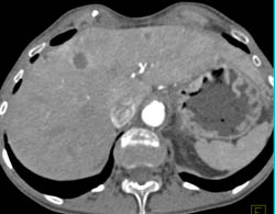 Metastatic Tumor of Tail of the Pancreas - CTisus CT Scan