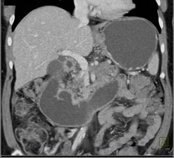 Pancreatic Cancer Obstructs the Duodenum - CTisus CT Scan