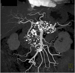 Chronic Pancreatitis With Pseudocysts - CTisus CT Scan