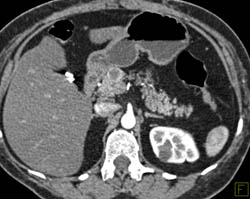 Cystic Islet Cell Tumor - CTisus CT Scan