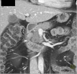 Pancreatic Head Tumor- Adenocarcinoma - CTisus CT Scan