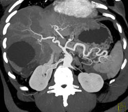 Pancreatic Tumor Encases the Splenic Artery - CTisus CT Scan