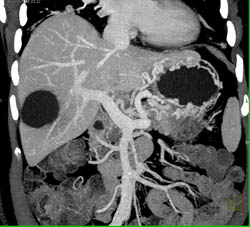 Pancreatic Tail Adenocarcinoma With Mets to Porta Hepatis - CTisus CT Scan