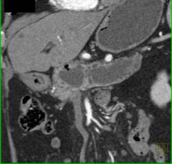 Central Intraductal Papillary Mucinous Neoplasm (IPMN) With Low Grade Malignancy - CTisus CT Scan