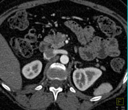 Pancreatic Adenocarcinoma - CTisus CT Scan