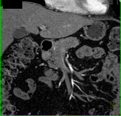 Pancreatic Adenocarcinoma - CTisus CT Scan