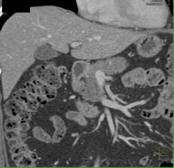 Pancreatic Adenocarcinoma - CTisus CT Scan