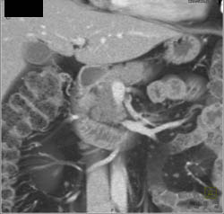 Pancreatic Adenocarcinoma - CTisus CT Scan