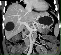 Carcinoma of the Pancreatic Tail Occludes the Splenic Vein With Collaterals - CTisus CT Scan