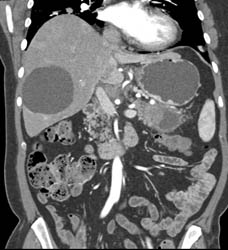 Pancreatic Cancer in Tail of Pancreas With Liver Metastases - CTisus CT Scan