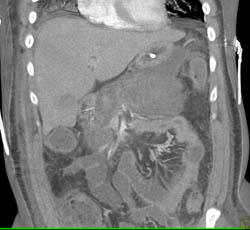 Acute Pancreatitis With Hemorrhagic Pancreatitis - CTisus CT Scan