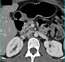 Dilated Pancreatic Duct With Tumor Obstructing the Pancreatic Duct - CTisus CT Scan