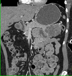 SPEN Tumor of the Tail of the Pancreas - CTisus CT Scan