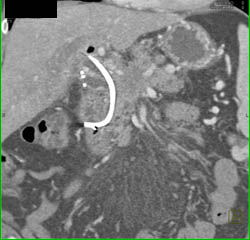 Islet Cell Tumor of the Pancreas Encases and Occludes the PV/SMV Junction With Collaterals - CTisus CT Scan