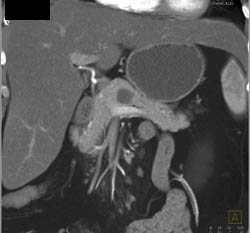 Intraductal Papillary Mucinous Neoplasm (IPMN) - CTisus CT Scan