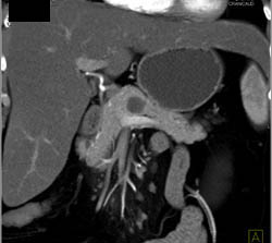 Intraductal Papillary Mucinous Neoplasm (IPMN) - CTisus CT Scan