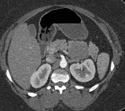 SPEN Tumor - CTisus CT Scan