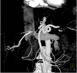 Pancreatic Cancer With Encased Hepatic Artery - CTisus CT Scan