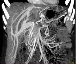 Pancreatic Cancer With Liver Metastases and PV/SMV Invasion - CTisus CT Scan