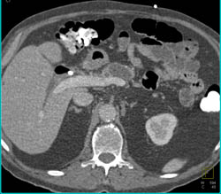 Pancreatic Cancer With Dilated Pancreatic Duct - CTisus CT Scan