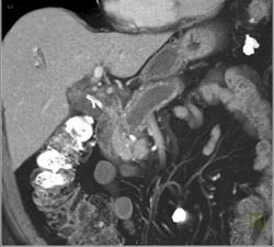 Pancreatic Cancer With Dilated Pancreatic Duct - CTisus CT Scan