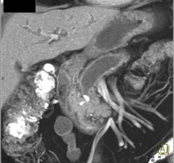 Pancreatic Cancer With Dilated Pancreatic Duct - CTisus CT Scan