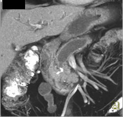 Pancreatic Cancer With Dilated Pancreatic Duct - CTisus CT Scan