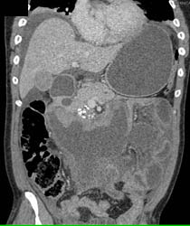 Pancreatic Cancer Obstructs the Duodenum at the Ligament of Trietz - CTisus CT Scan