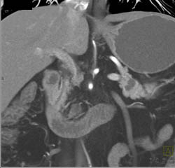 Intraductal Papillary Mucinous Neoplasm (IPMN) - CTisus CT Scan