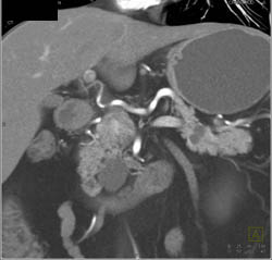 Intraductal Papillary Mucinous Neoplasm (IPMN) - CTisus CT Scan