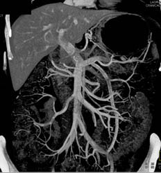 Intraductal Papillary Mucinous Neoplasm (IPMN) - CTisus CT Scan