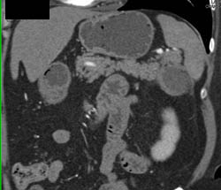 Intraductal Papillary Mucinous Neoplasm (IPMN) in the Tail of the Pancreas - CTisus CT Scan