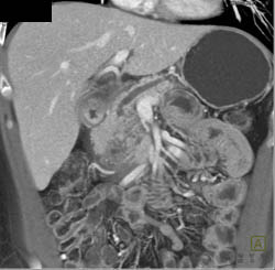 Cystic Pancreatic Mass - CTisus CT Scan