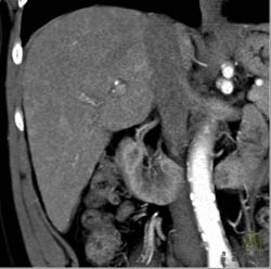 Islet Cell Tumor of the Pancreas With Vascular Liver Metastases - CTisus CT Scan