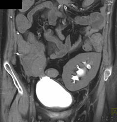 Pancreatic and Renal Transplant - CTisus CT Scan