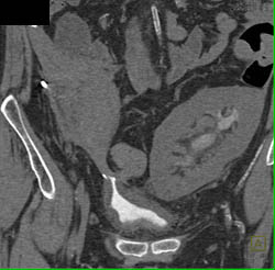 Cystadenoma of the Pancreas - CTisus CT Scan