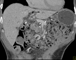 Chronic Pancreatitis Narrows the Superior Mesenteric Vein (SMV) - CTisus CT Scan