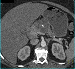 Cystadenoma of the Pancreas - CTisus CT Scan