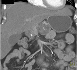 Cystadenoma of the Pancreas - CTisus CT Scan