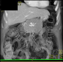 Cystadenocarcinoma - CTisus CT Scan