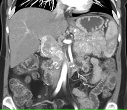 Islet Cell Tumor Involves the Entire Pancreas and Invades the Portal Vein With Collaterals - CTisus CT Scan