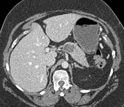 Intraductal Papillary Mucinous Neoplasm (IPMN) - CTisus CT Scan