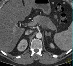 Lymphoma of the Pancreas - CTisus CT Scan