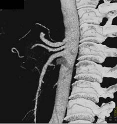 Hepatic Artery Arises Directly Off the Aorta - CTisus CT Scan