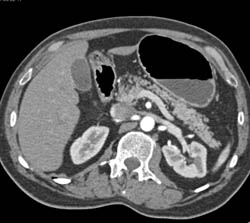 Subtle Carcinoma of the Pancreas in the Body - CTisus CT Scan