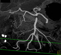 Normal Celiac and SMA - CTisus CT Scan