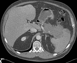 Carcinoma of the Tail of Th Epancreas Invades the Spleen - CTisus CT Scan