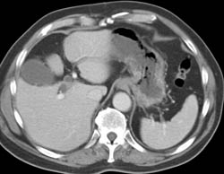 Pancreatic Cancer in the Head of the Pancreas - CTisus CT Scan