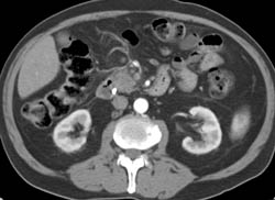 Pancreatic Cancer Obstructs the Common Bile Duct (CBD) - CTisus CT Scan